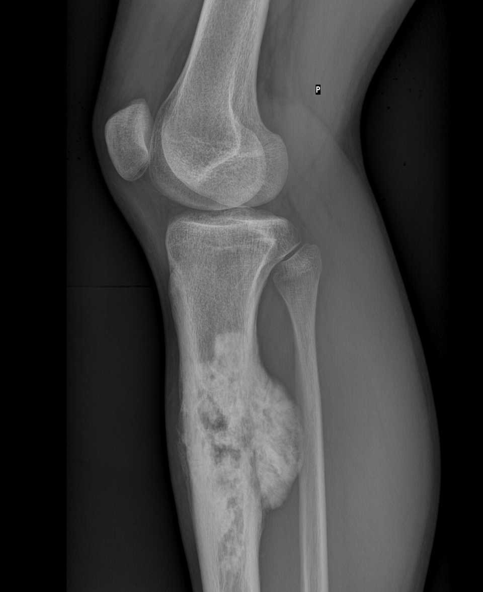Osteosarkóm píštaly
